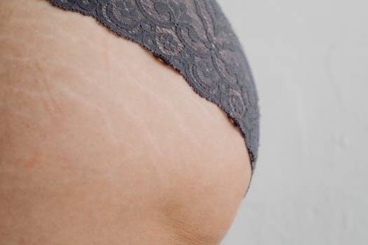 Top 10 Sfaturi pentru Alegerea Cea Mai Confortabilă Lenjerie Intimă 4 A detailed view of skin with stretch marks wearing lace lingerie, highlighting natural beauty.